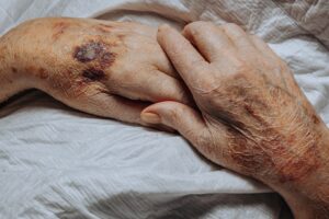 A bruise on the hand of an elderly person